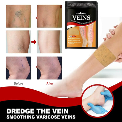 Varicose Veins Health Care Paste | Pain Relief & Blood Circulation Support